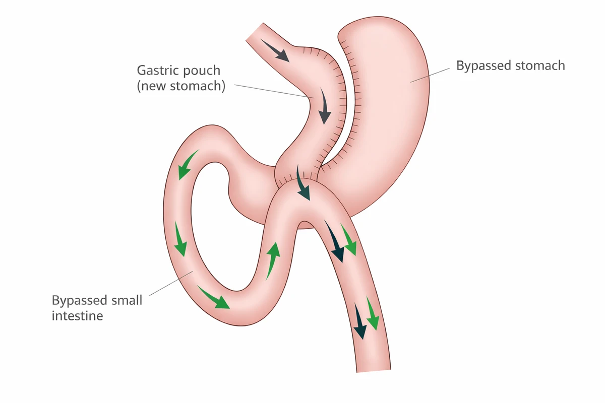 Diagram of a gastric bypass showing the new stomach pouch and the bypassed stomach and small intestine