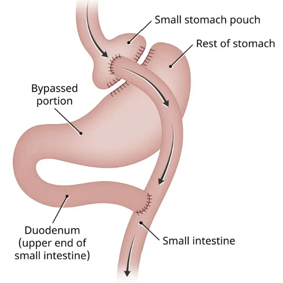 Diagram of a gastric bypass showing the small stomach pouch, the bypassed portion and the small intestine