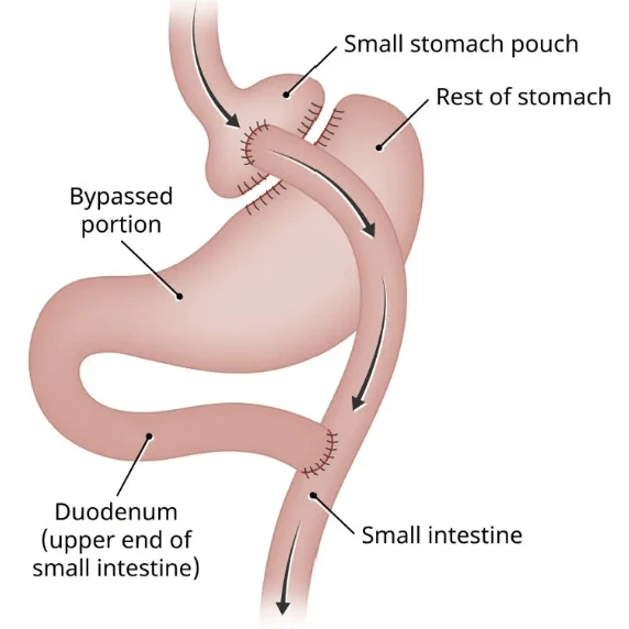 Diagram of a gastric bypass showing the small stomach pouch, the bypassed portion and the small intestine