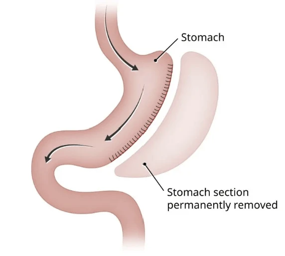 Diagram of a gastric sleeve showing the section of stomach that is removed