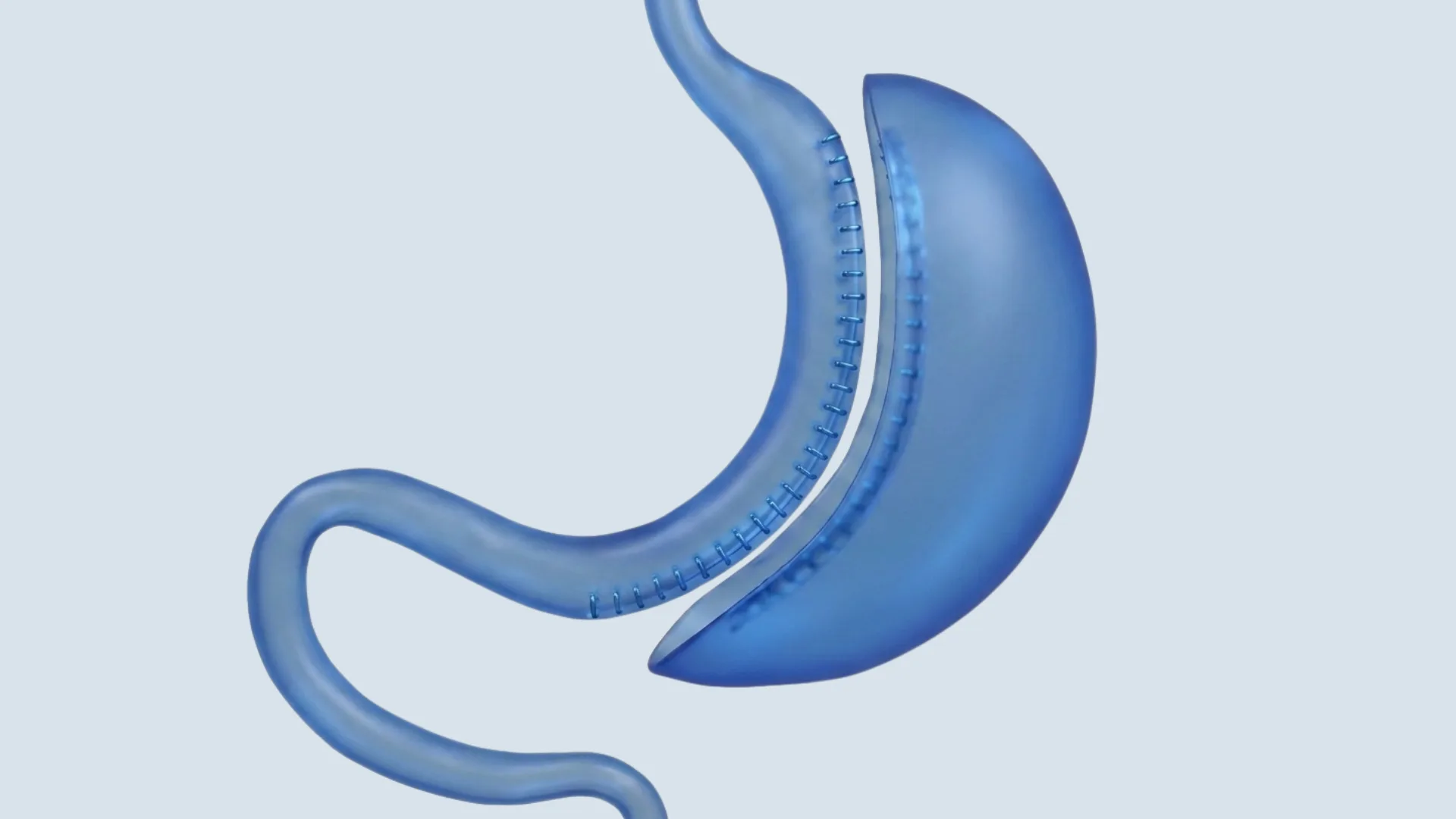 Illustration of a gastric sleeve showing the section of stomach that is removed