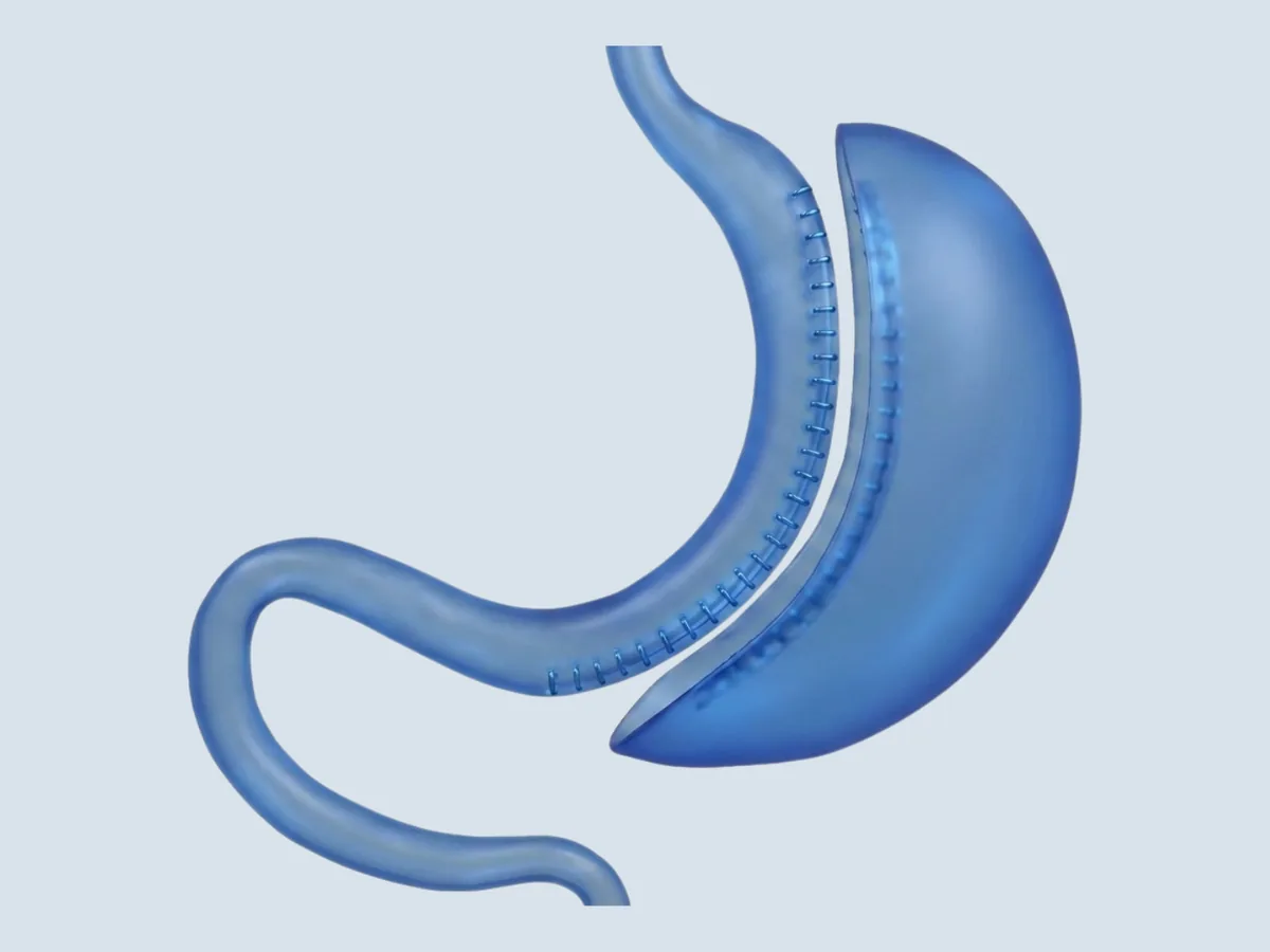 Gastric Sleeve surgical procedure illustration