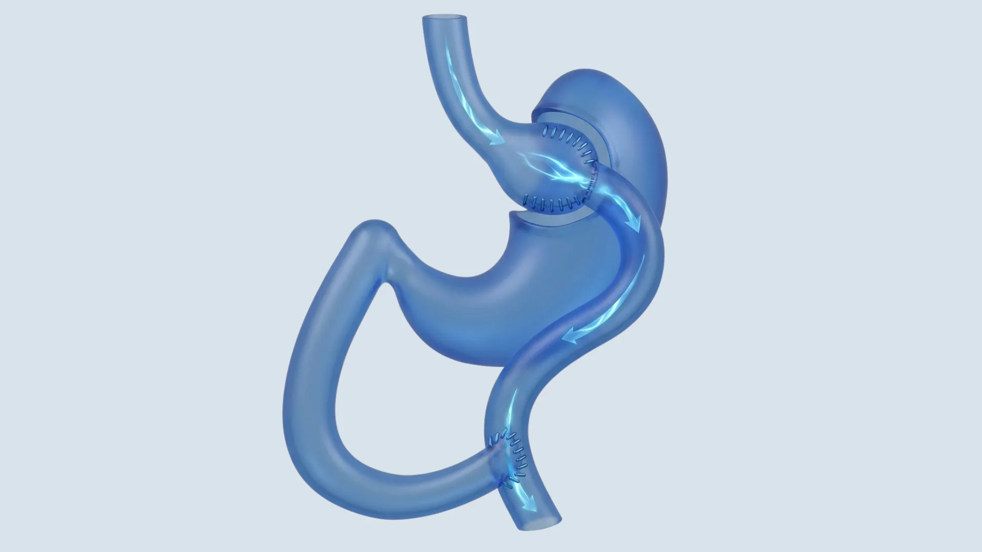 Diagram illustrating the Roux-en-Y Gastric Bypass procedure